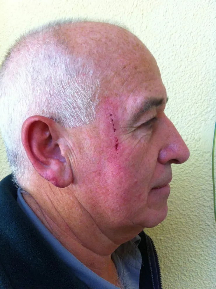Allen sufrió un corte en la cara. 
