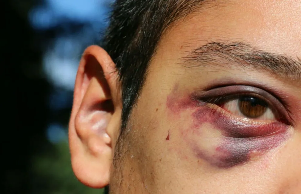 El joven de 19 años fue golpeado por cinco patovicas.