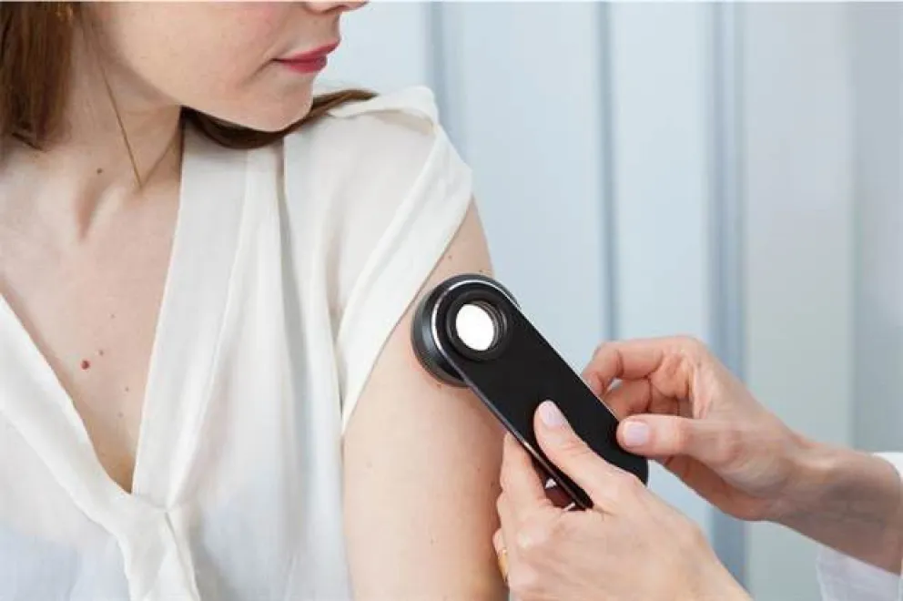 Un examen gratuito para prevenir el cáncer de piel