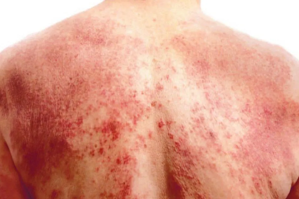 Dermatitis atópica: una enfermedad que pica, duele, se infecta y es difícil de tratar