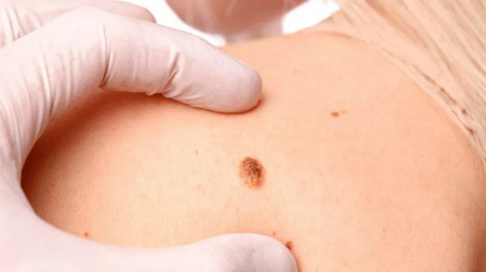 Cáncer de piel: exámenes gratuitos en el hospital