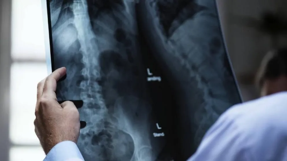 Osteoporosis: factores de riesgo y la importancia de realizarse estudios de control